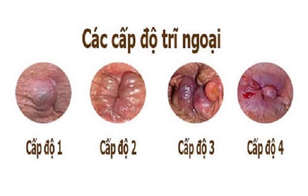 Bệnh trĩ ngoại