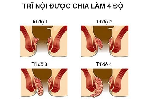 Bệnh trĩ nội - Khi nào cần phẫu thuật cắt trĩ ?