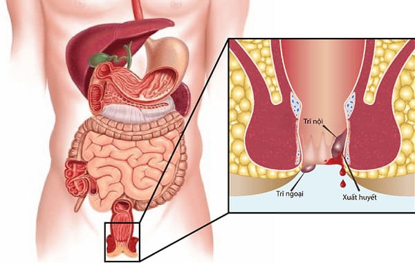 Nhận biết bệnh trĩ sau sinh qua các dấu hiệu thường gặp