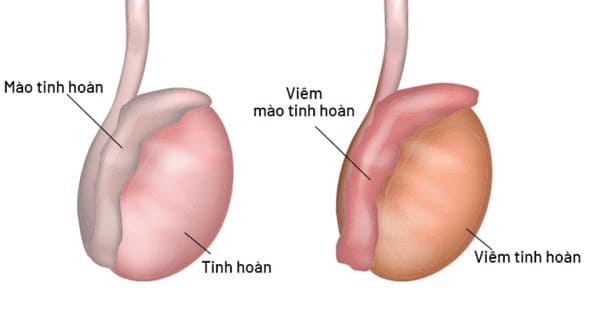 Nguyên nhân dẫn đến nhức tinh hoàn phải: Viêm tinh hoàn