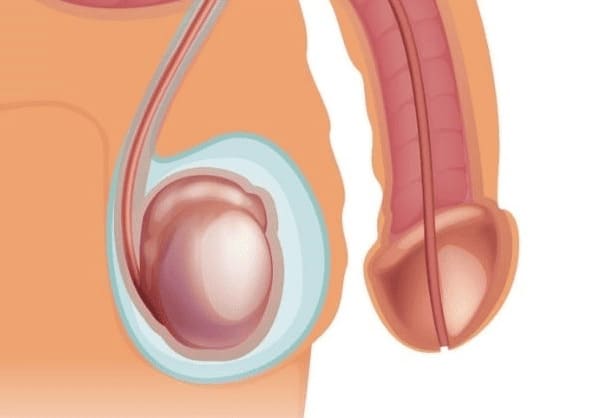 Nguyên nhân dẫn đến nhức tinh hoàn phải: Tràn dịch màng tinh hoàn