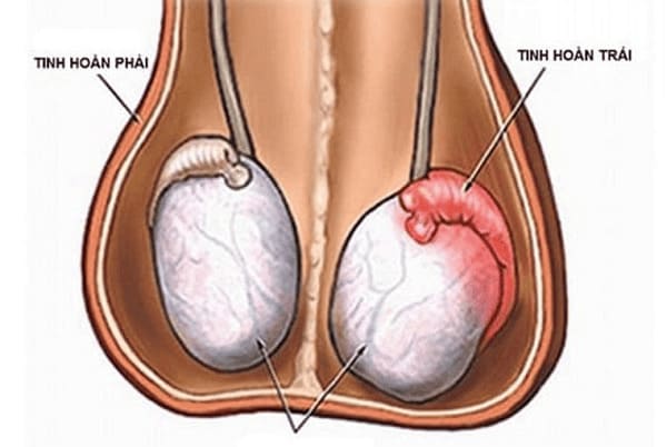 Đau nhức tinh hoàn trái ở nam giới