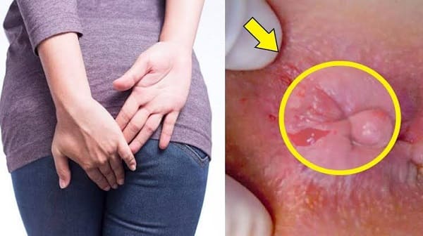 Trường hợp nữ giới bị trĩ nhẹ