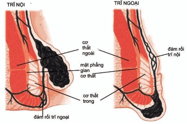 Bị tắc mạch búi trĩ