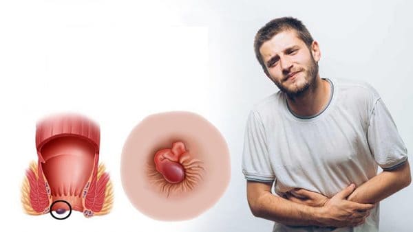Sử dụng cây chữa bệnh trĩ có hiệu quả không?