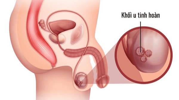 U tinh hoàn lành tính ở nam