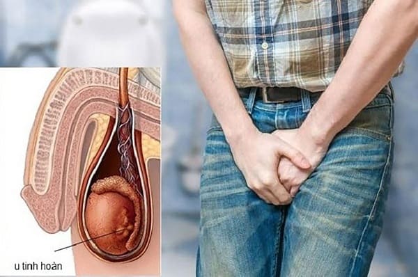 U tinh hoàn lành tính có nguy hiểm không?