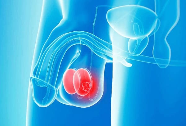 Biểu hiện vôi hóa tinh hoàn ở nam giới