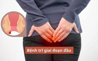 Nhận biết bệnh trĩ giai đoạn đầu – Cách xử trí hiệu quả