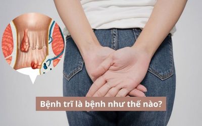 Bác sĩ chuyên khoa giải đáp: Bệnh trĩ là bệnh như thế nào? 