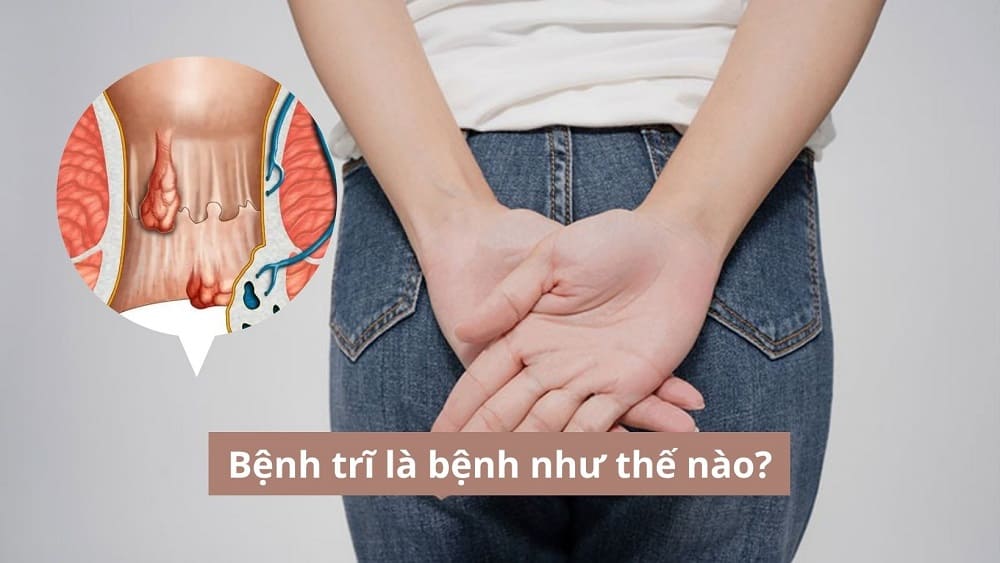 Bệnh trĩ là bệnh như thế nào?