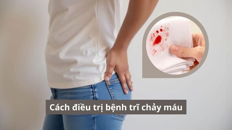 Cách điều trị bệnh trĩ chảy máu