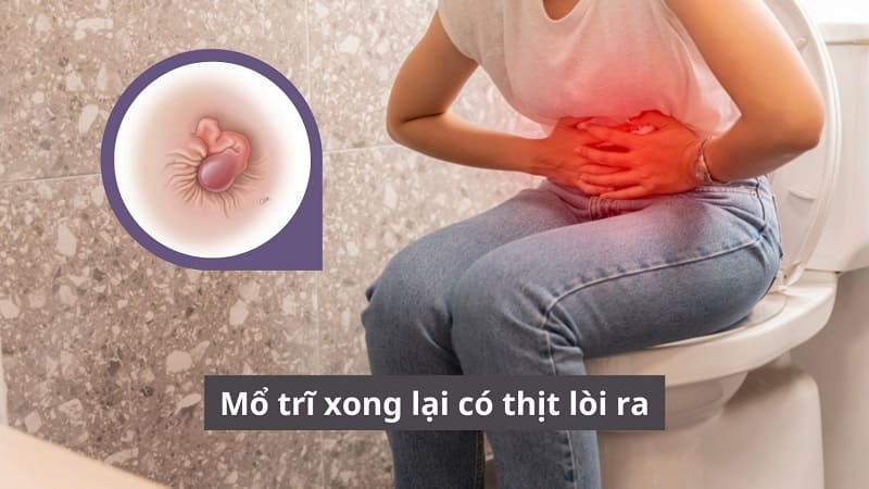 Mổ trĩ xong lại có thịt lòi ra