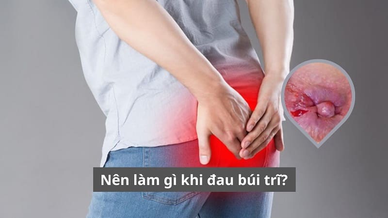 Nên làm gì khi đau búi trĩ?