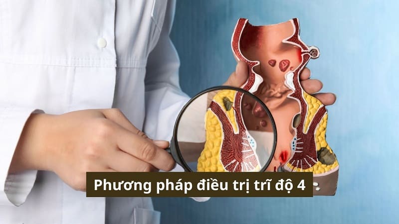 Phương pháp điều trị trĩ độ 4