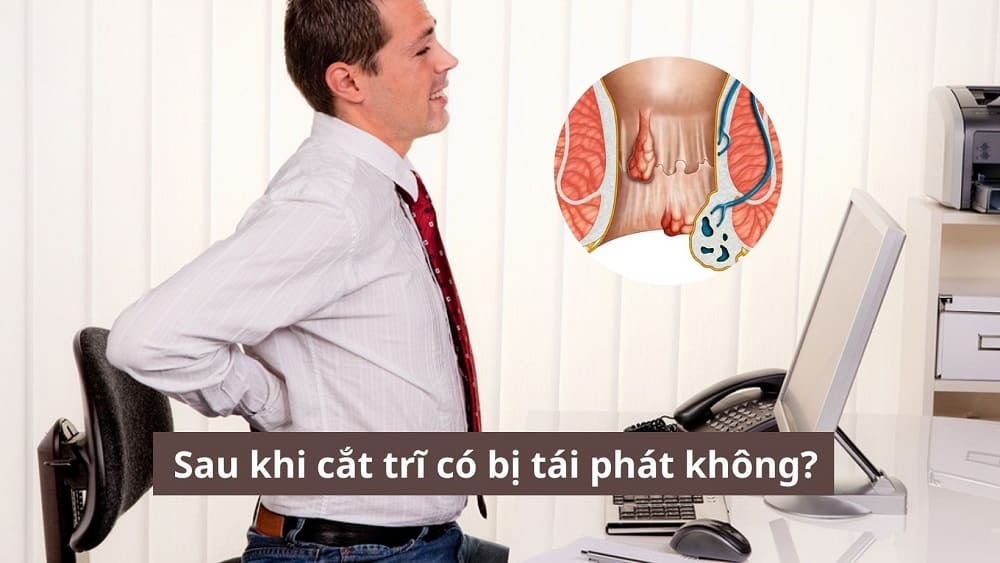 Sau khi cắt trĩ có bị tái phát không?