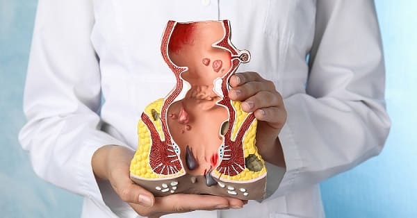 Triệu chứng của bệnh trĩ trong giai đoạn đầu