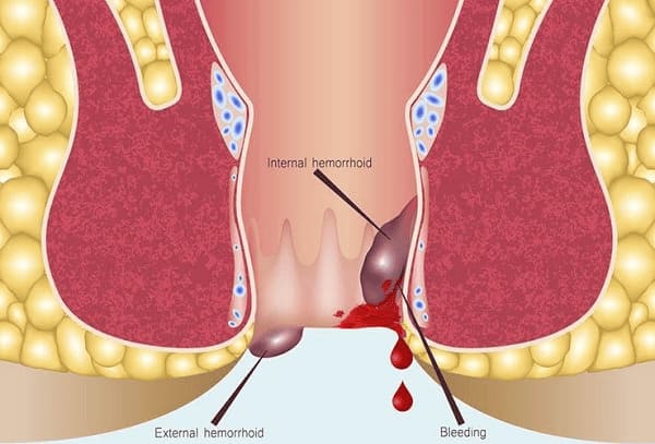 Dấu hiệu nhận biết bệnh trĩ chảy máu