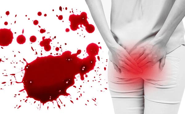 Vì đâu dẫn đến tình trạng bệnh trĩ chảy máu?