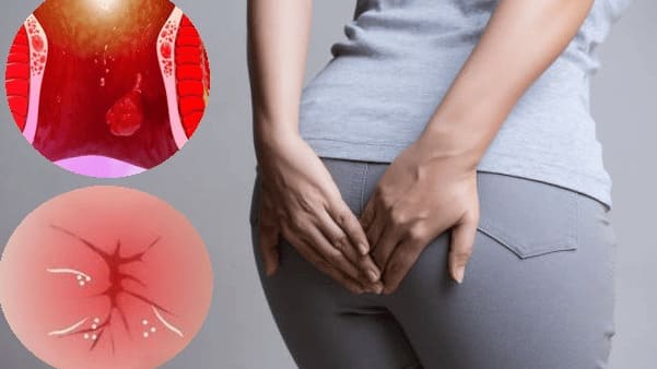 Tại sao cần đi khám trĩ càng sớm càng tốt?