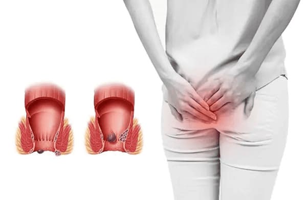 Mổ trĩ xong lại có thịt lòi ra: Cảnh báo bệnh trĩ tái phát