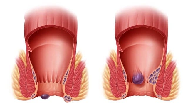 Tổng quan về bệnh trĩ