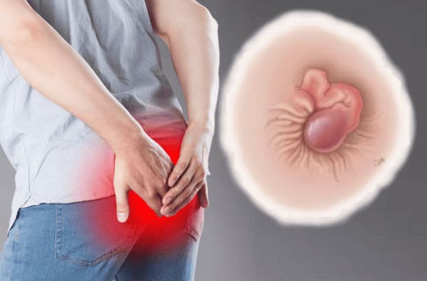 Đau búi trĩ thường kéo dài bao lâu?