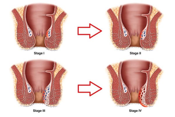 Các cấp độ bệnh trĩ