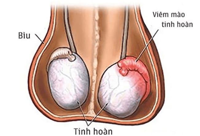 Viêm mào tinh hoàn