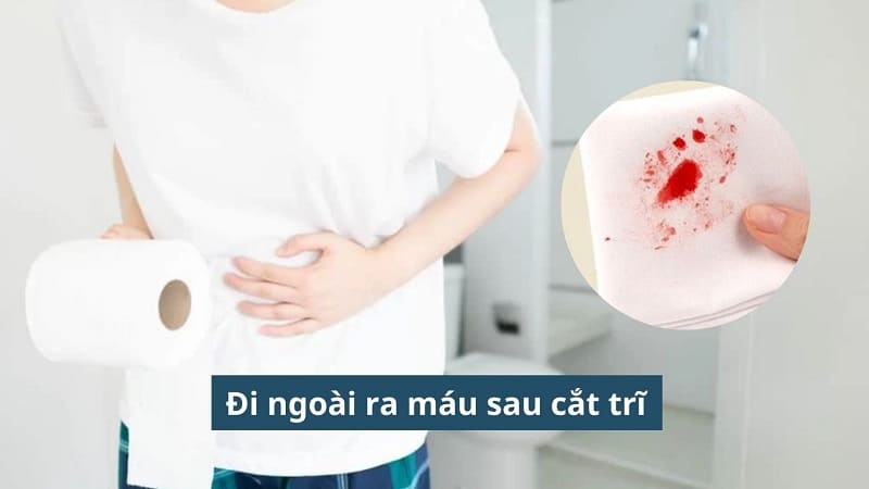 Đi ngoài ra máu sau cắt trĩ