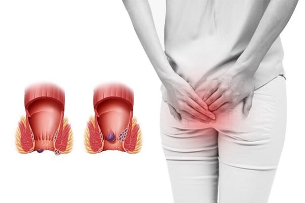 Nhận biết bệnh trĩ bằng cách nào?
