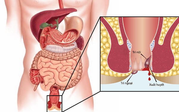 Trĩ nếu không chữa sẽ gây ra tác hại gì?