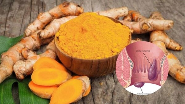 Tìm hiểu công dụng của củ nghệ tươi trong điều trị bệnh trĩ