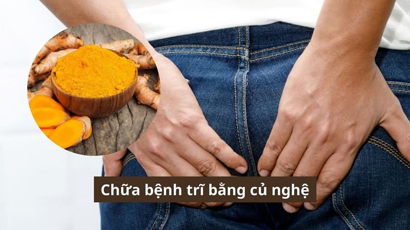 Chữa bệnh trĩ bằng củ nghệ