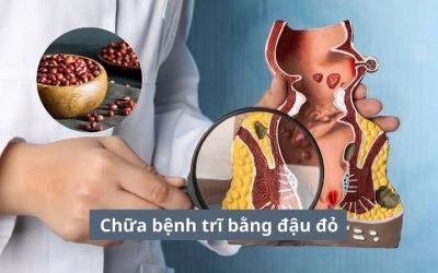 Chữa bệnh trĩ bằng đậu đỏ có hiệu quả không?