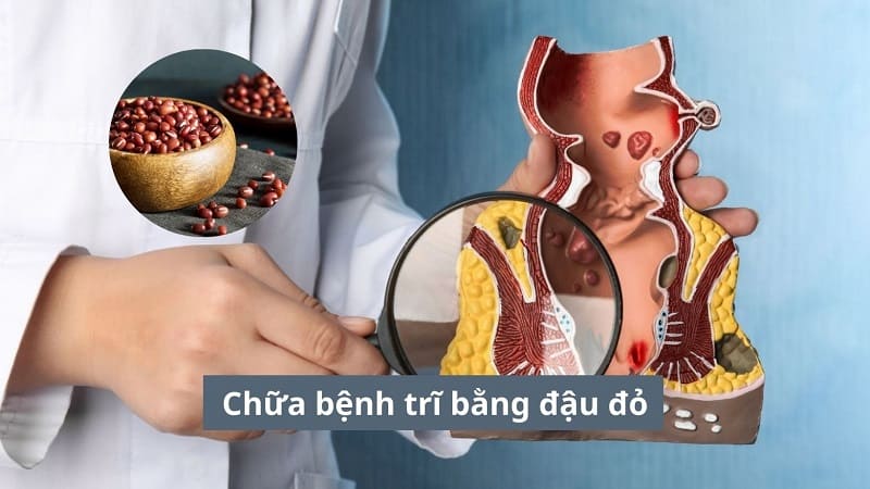 Chữa bệnh trĩ bằng đậu đỏ