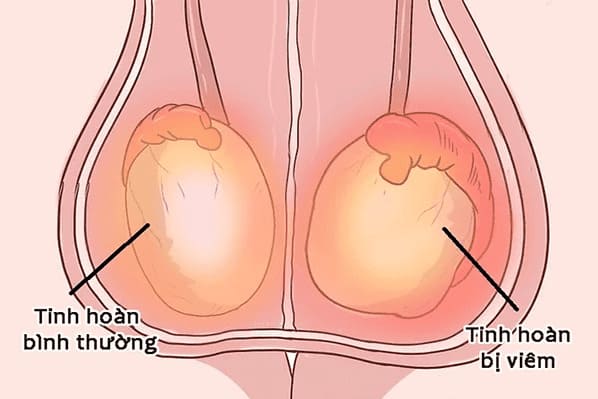 Đau bụng dưới và tinh hoàn khi bị kích thích - do viêm tinh hoàn