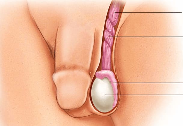Đau bụng dưới và tinh hoàn khi bị kích thích - do xoắn tinh hoàn