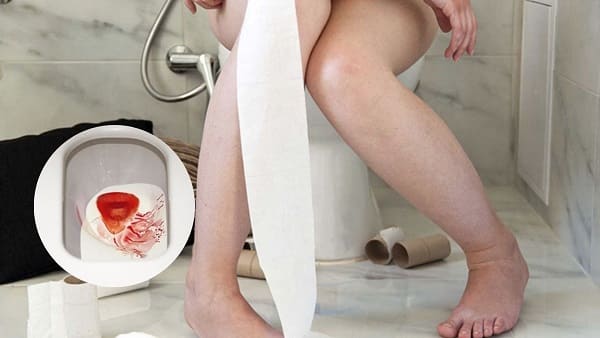 Các biến chứng có thể gặp sau khi thực hiện phẫu thuật cắt trĩ 