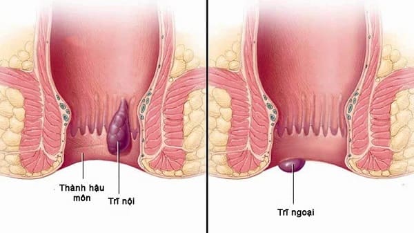 Bệnh trĩ xuất hiện do đâu? 